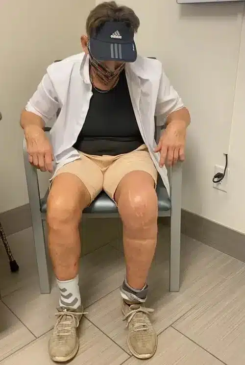 revision knee surgery testimony