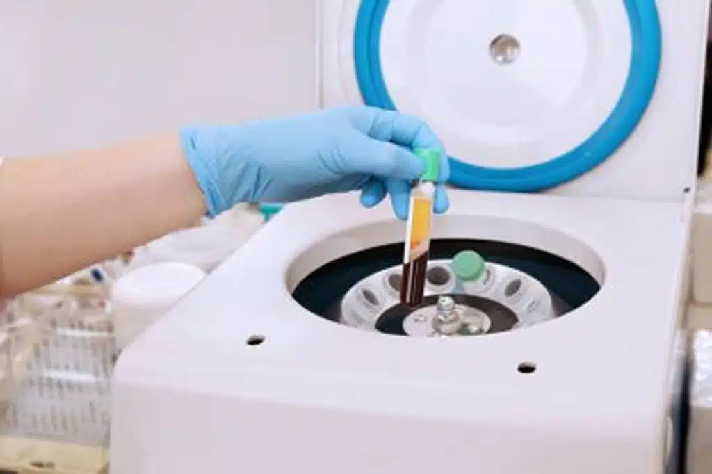 PRP injection palm beach florida medical tube with blood plasma