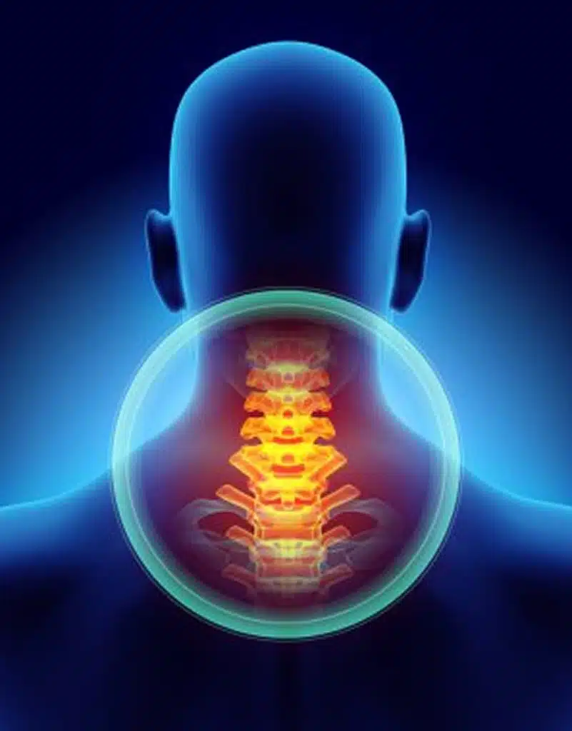neck pain management jupiter florida neck painful cervica spine skeleton
