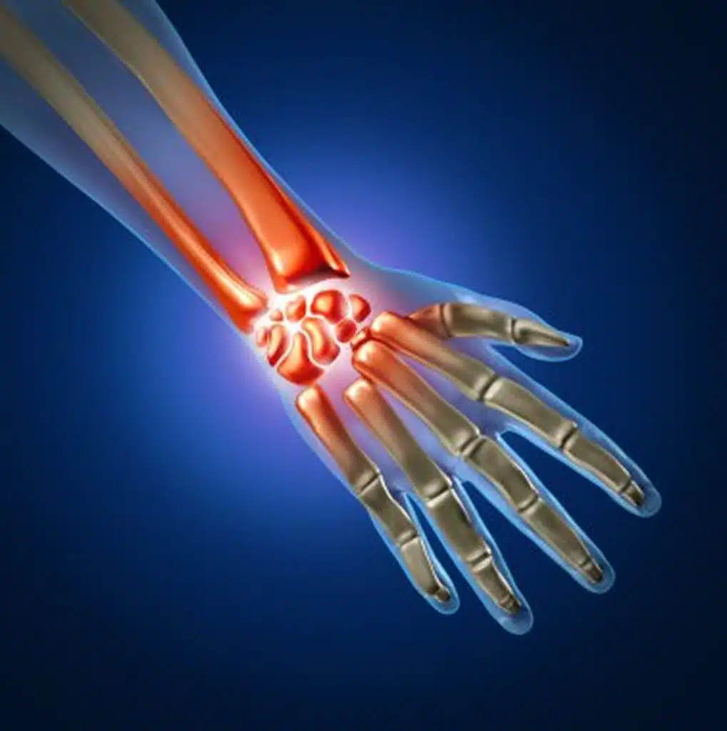 tendonitis treatment florida hand pain illustration