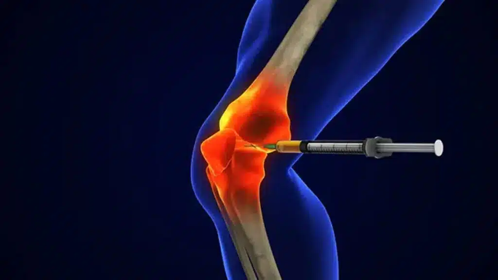 stem cell therapy for knee pain wellington florida photo anatomy human knee joint treatment