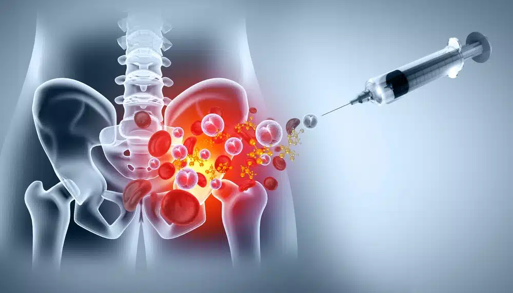 Platelet rich plasma therapy Wellington Florida for pelvis and hip bones