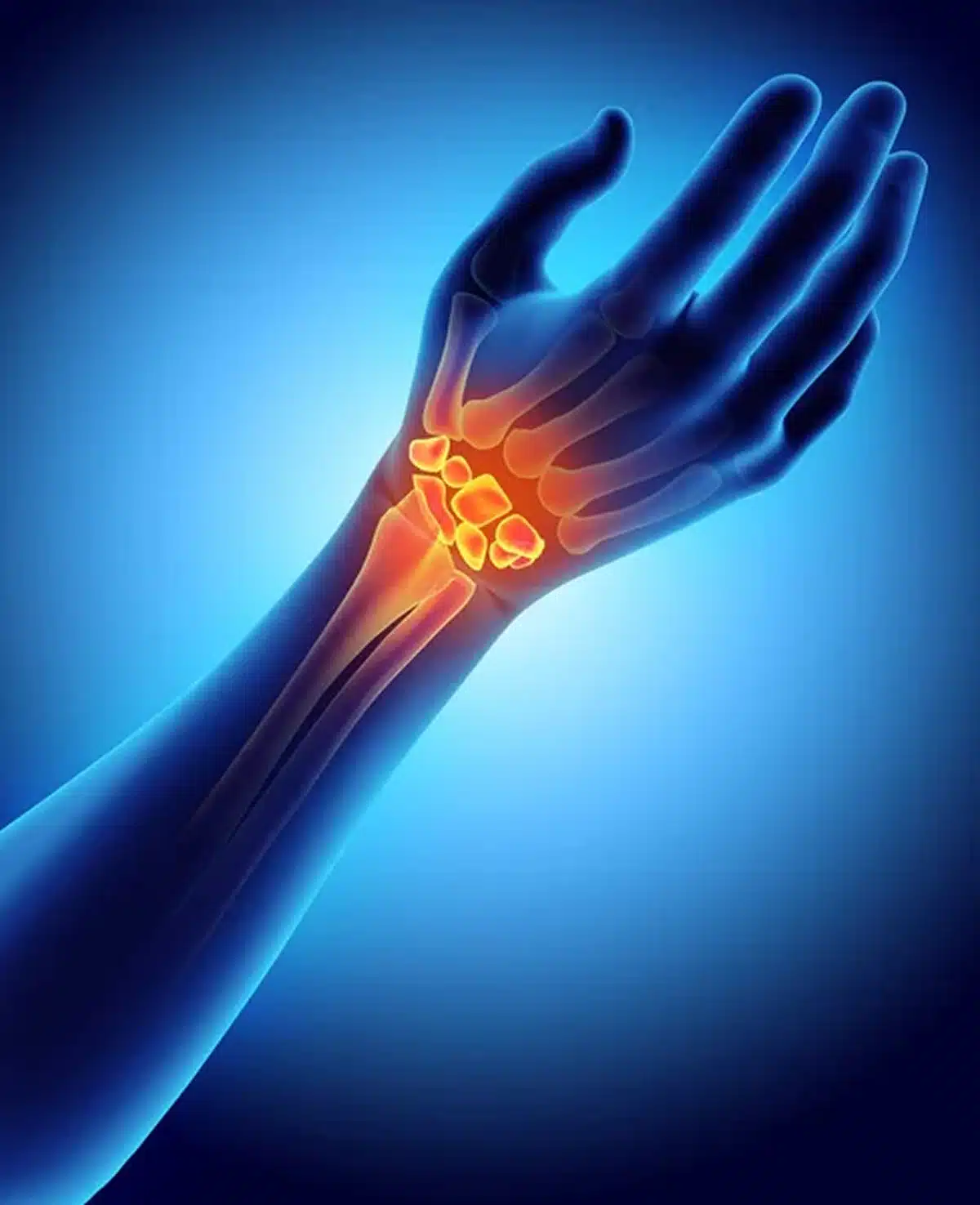 Tendonitis Treatment in Jupiter, Florida 3d illustration of carpal medical