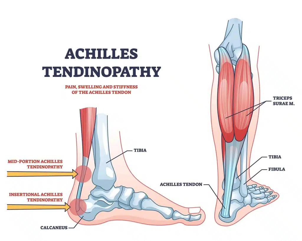Achilles tendinitis treatment wellington florida