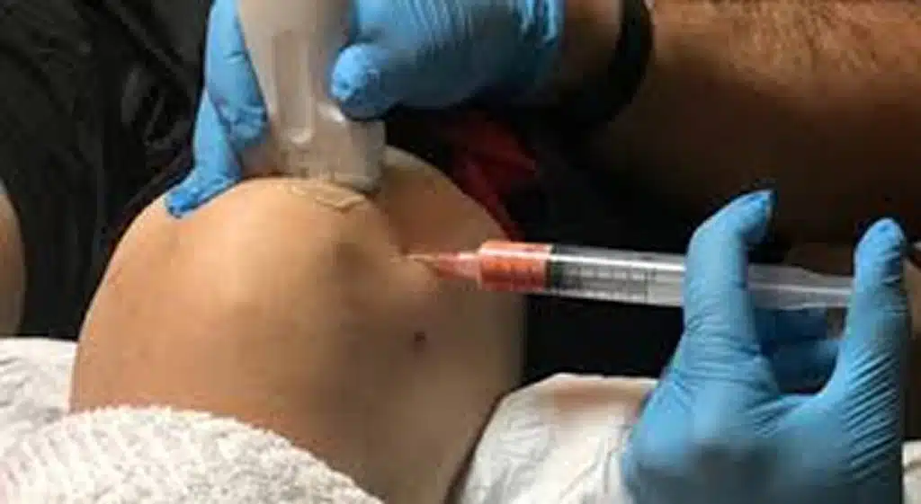 Adipose Derived Stem Cell Therapy Injection Near West Clarke Road Sebring Florida