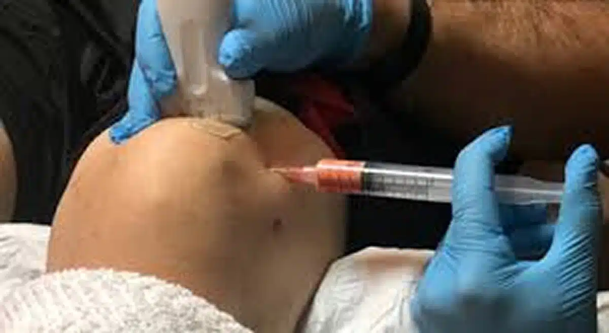 Adipose Derived Stem Cell Therapy Injection Near West Clarke Road Sebring Florida