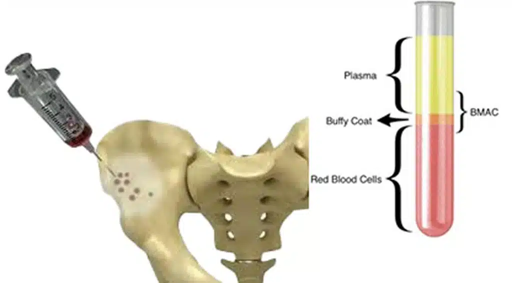 bmac injection illustration in jupiter florida