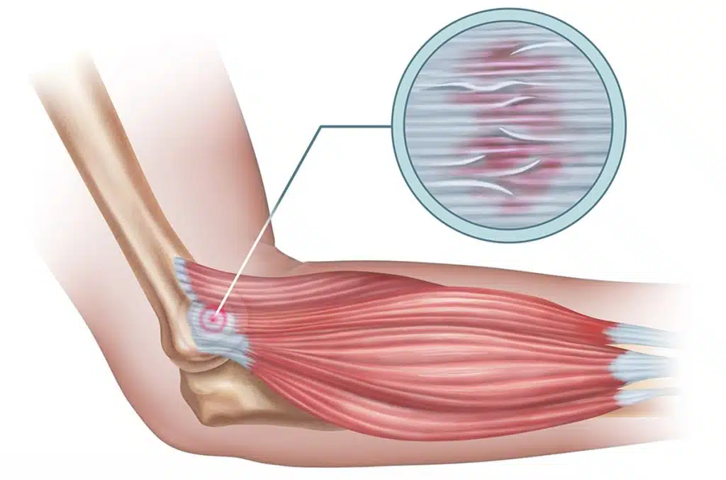 illustration of golfer elbow treatment sebring florida 2