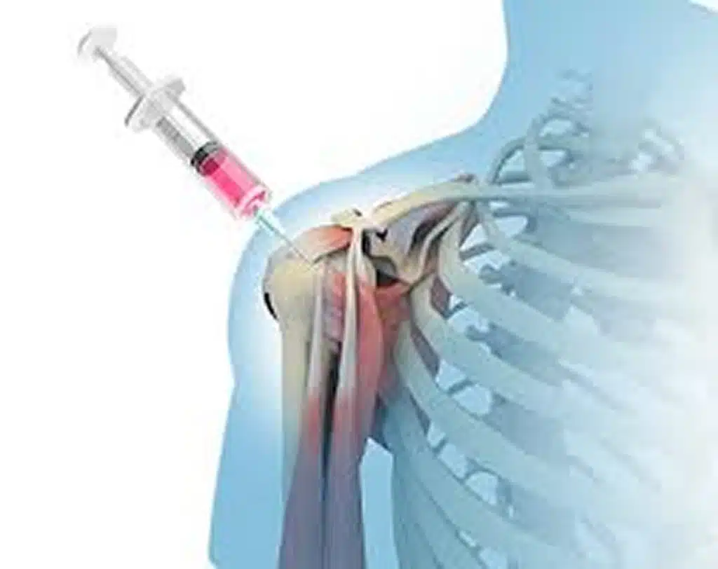 stem cell therapy for shoulder pain near lime drive wellington florida injection