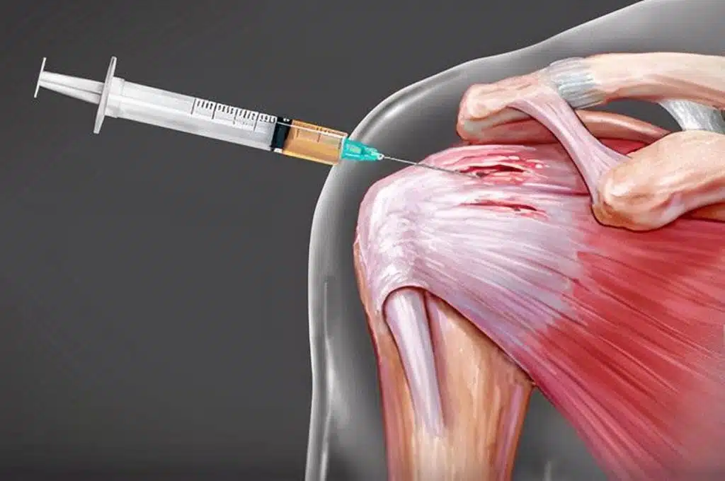 PRP injected for Rotator Cuff Tendinopathy shoulder in Jupiter florida 1