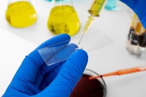 bone marrow aspirate concentrate treatment florida sample bone marrow aspirate concentrate treatment florida sample